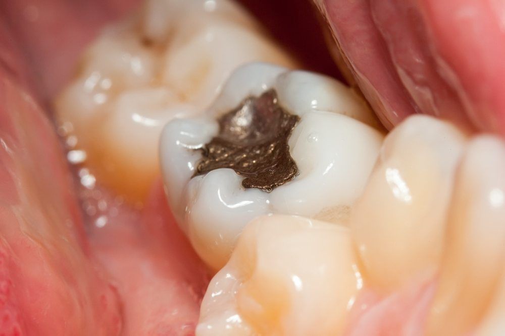 Amalgam Fillings » Des Moines Family Dentistry Des Moines, IA